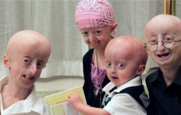 الشيخوخة المبكرة من أمثلة الأمراض النادرة