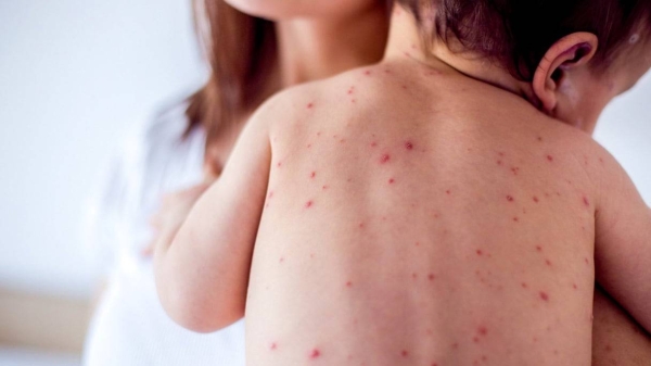 تراجع حالات الإصابة ببوحمرون