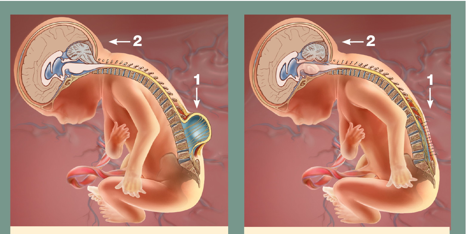 2017-03-0917_40_12.792674-spina-bifida-repair-edit