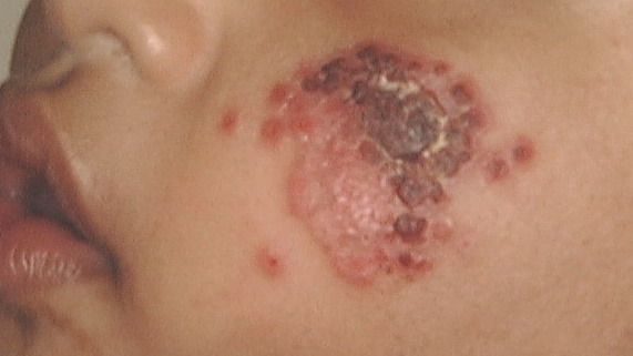 cutaneous_leishmaniasis6