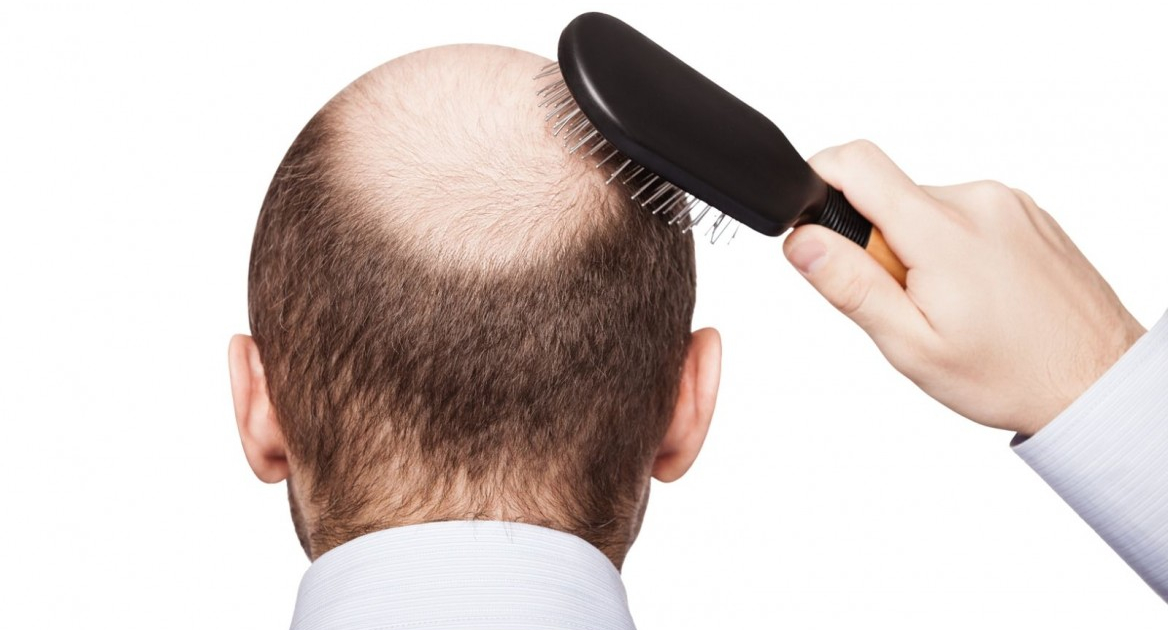 shutterstock_bald-1168x657-1168x630